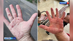 В России стремительно распространяется вирус Коксаки