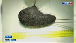 Алтайские хирурги достали из желудка ребёнка огромный комок волос