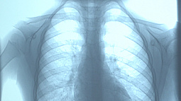 На Алтае растет заболеваемость детским туберкулезом